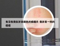 有没有类似淤青颜色的癣图片 像淤青一样的痘痘