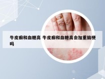 牛皮癣和血糖高 牛皮癣和血糖高会加重脑梗吗