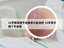 11岁刚发现牛皮癣多久能治好 12岁孩子得了牛皮癣