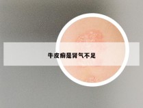 牛皮癣是肾气不足