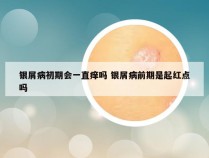 银屑病初期会一直痒吗 银屑病前期是起红点吗