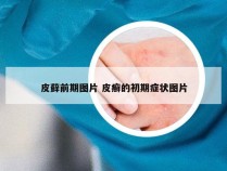 皮藓前期图片 皮癣的初期症状图片