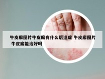 牛皮廨图片牛皮廨有什么后遗症 牛皮廨图片 牛皮廨能治好吗