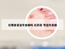红霉素膏治牛皮癣吗 红药膏 专治牛皮癣