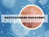 槐米茶可以治疗银屑病吗 槐米茶治疗便秘吗?
