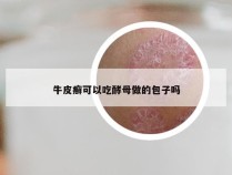 牛皮癣可以吃酵母做的包子吗