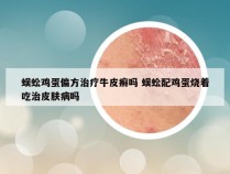 蜈蚣鸡蛋偏方治疗牛皮癣吗 蜈蚣配鸡蛋烧着吃治皮肤病吗