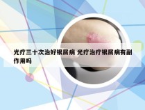 光疗三十次治好银屑病 光疗治疗银屑病有副作用吗