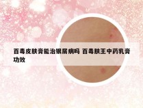百毒皮肤膏能治银屑病吗 百毒肤王中药乳膏功效