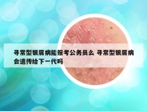 寻常型银屑病能报考公务员么 寻常型银屑病会遗传给下一代吗