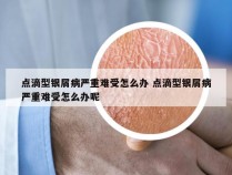 点滴型银屑病严重难受怎么办 点滴型银屑病严重难受怎么办呢