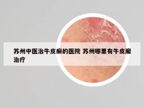 苏州中医治牛皮癣的医院 苏州哪里有牛皮廨治疗