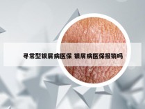 寻常型银屑病医保 银屑病医保报销吗