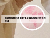 银屑病角质形成细胞 银屑病角质层不脱落的原因