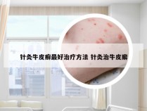 针灸牛皮癣最好治疗方法 针灸治牛皮廨