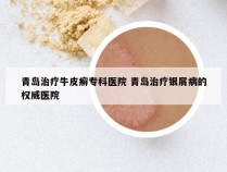 青岛治疗牛皮癣专科医院 青岛治疗银屑病的权威医院