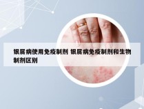 银屑病使用免疫制剂 银屑病免疫制剂和生物制剂区别