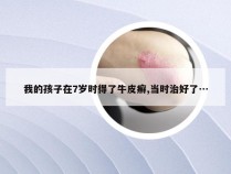 我的孩子在7岁时得了牛皮癣,当时治好了…