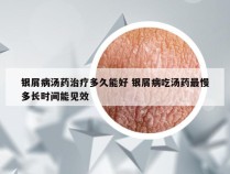 银屑病汤药治疗多久能好 银屑病吃汤药最慢多长时间能见效