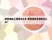 银屑病身上很痒怎么办 银屑病患处很痒怎么办?