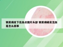 银屑病皮下出血点图片头部 银屑病破皮流血是怎么回事