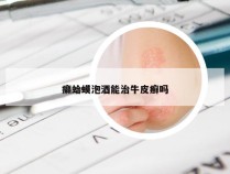 癞蛤蟆泡酒能治牛皮癣吗