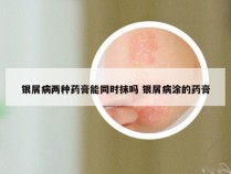 银屑病两种药膏能同时抹吗 银屑病涂的药膏