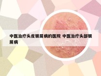 中医治疗头皮银屑病的医院 中医治疗头部银屑病