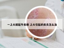 一上火就起牛皮癣 上火引起的皮炎怎么治