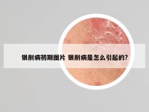 银削病初期图片 银削病是怎么引起的?