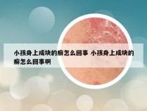 小孩身上成块的癣怎么回事 小孩身上成块的癣怎么回事啊