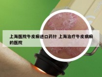 上海医院牛皮癣进口药针 上海治疗牛皮病癣的医院