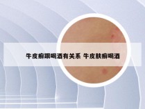 牛皮癣跟喝酒有关系 牛皮肤癣喝酒