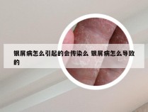 银屑病怎么引起的会传染么 银屑病怎么导致的