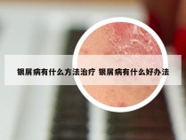 银屑病有什么方法治疗 银屑病有什么好办法