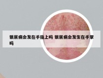 银屑病会发在手指上吗 银屑病会发生在手掌吗