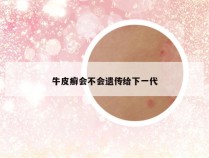 牛皮癣会不会遗传给下一代