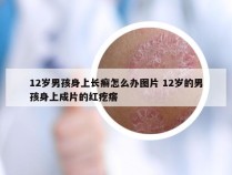 12岁男孩身上长癣怎么办图片 12岁的男孩身上成片的红疙瘩