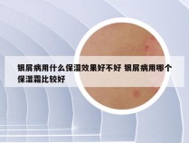 银屑病用什么保湿效果好不好 银屑病用哪个保湿霜比较好