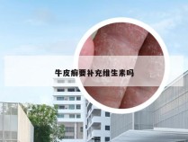 牛皮癣要补充维生素吗