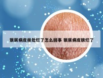 银屑病皮损处烂了怎么回事 银屑病皮肤烂了