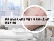 银屑病为什么吃药后严重了 银屑病一直吃药就是不消退