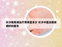 长沙银屑病治疗费用是多少 长沙中医治银屑病好的医生