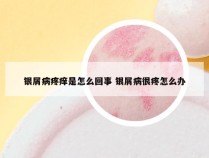 银屑病疼痒是怎么回事 银屑病很疼怎么办