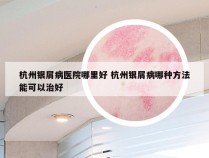 杭州银屑病医院哪里好 杭州银屑病哪种方法能可以治好