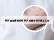 银屑病加重咽喉痛 银屑病患者嗓子疼怎么办
