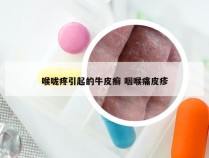 喉咙疼引起的牛皮癣 咽喉痛皮疹