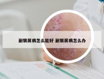 副银屑病怎么能好 副银屑病怎么办