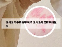 温州治疗牛皮癣哪家好 温州治疗皮肤病的医院