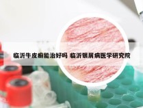 临沂牛皮癣能治好吗 临沂银屑病医学研究院